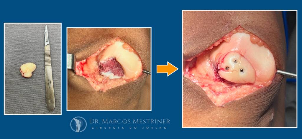 Lesão condral
Lesão osteocondral
Joelho
Cirurgia
Reparo
Fixação