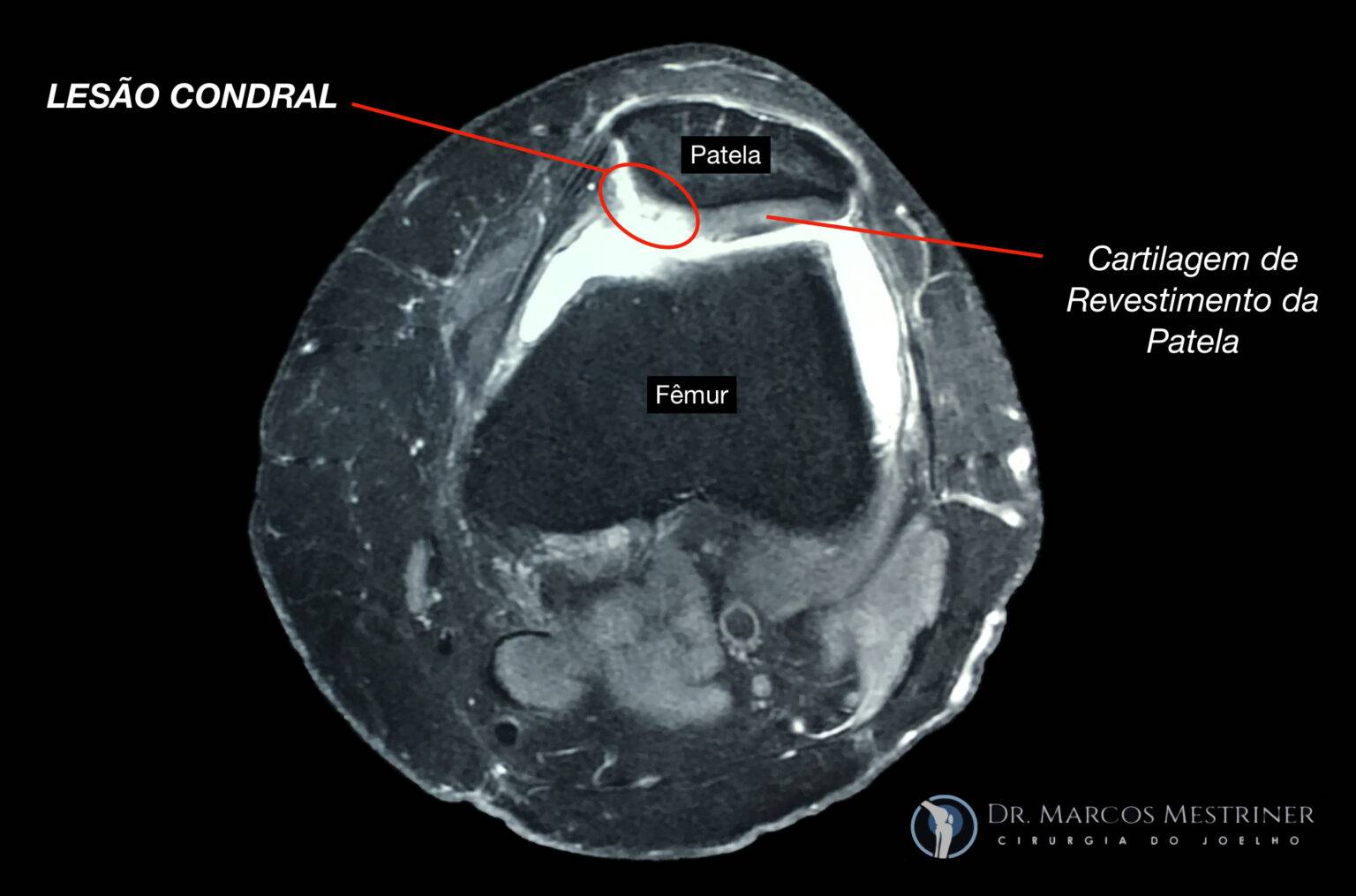 Lesão Condral e Osteocondral do Joelho: Entenda o Que São e Quais as ...