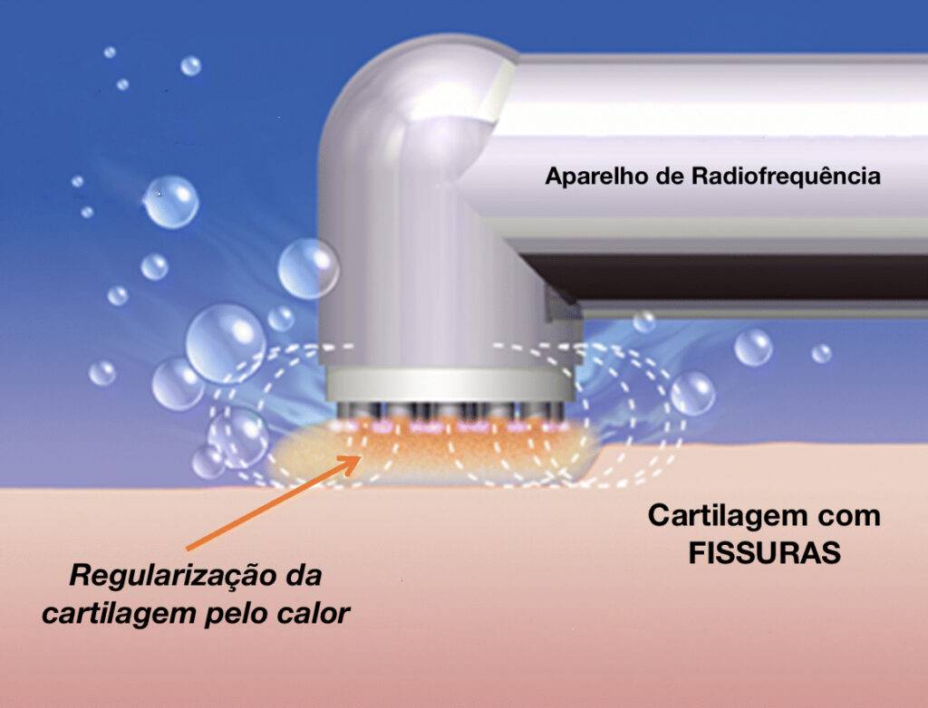 Lesão condral
Lesão osteocondral
Joelho
Cirurgia
Desbridamento e regularização
Radiofrequência