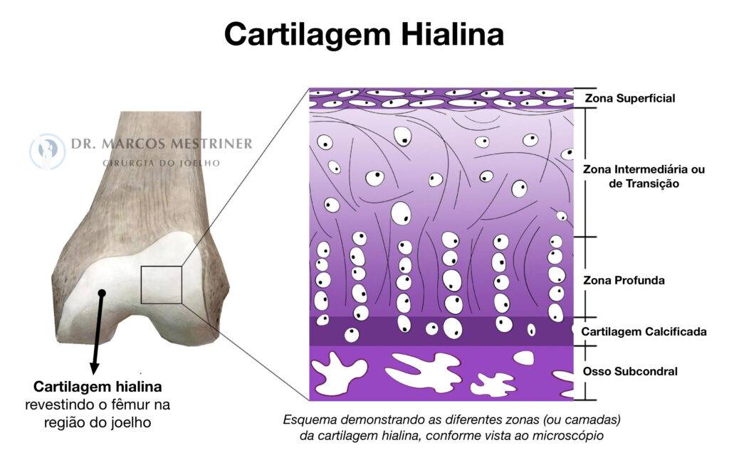 Lesão condral
Lesão osteocondral
Joelho
Cartilagem hialina