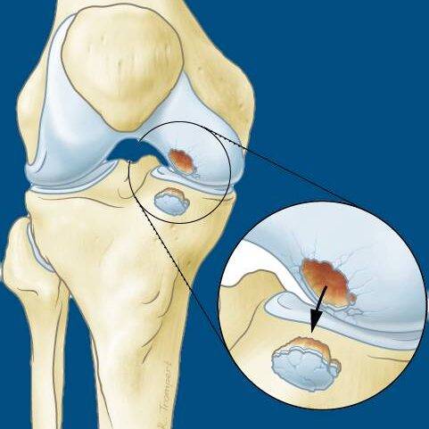 Lesão condral
Lesão osteocondral
Joelho
