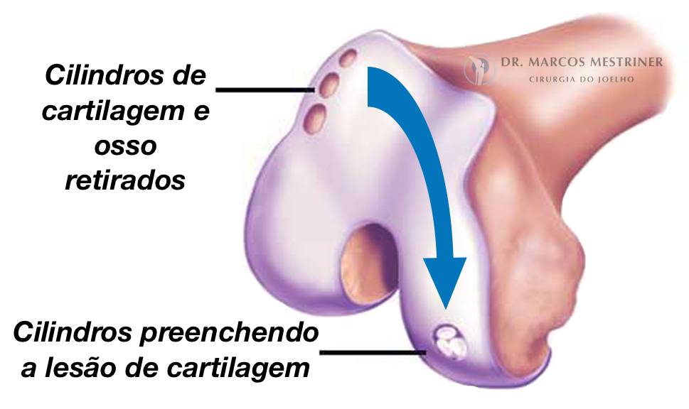 Lesão condral
Lesão osteocondral
Joelho
Cirurgia
Mosaicoplastia
OATS