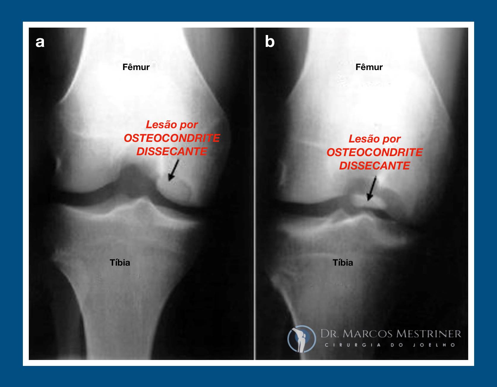 Lesão Condral e Osteocondral do Joelho: Entenda o Que São e Quais as ...