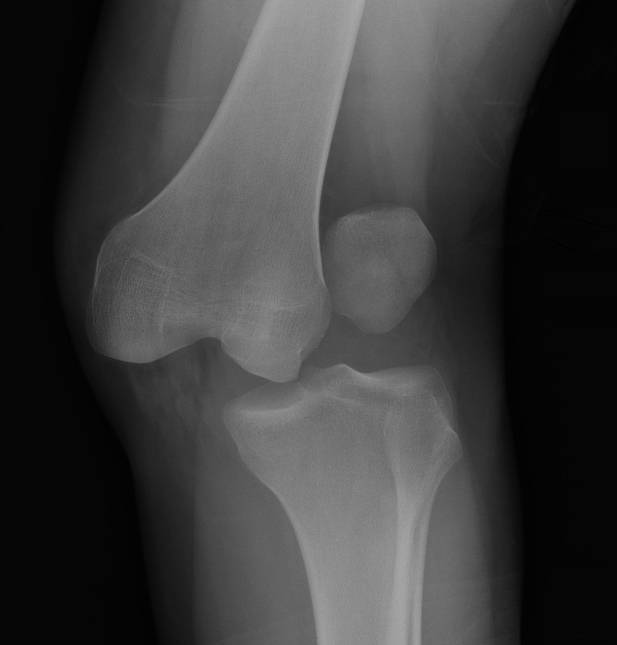 Luxação do Joelho
Radiografia