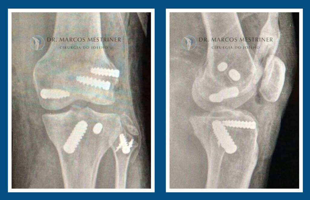 Luxação de Joelho
Radiografias
Reconstrução ligamentar